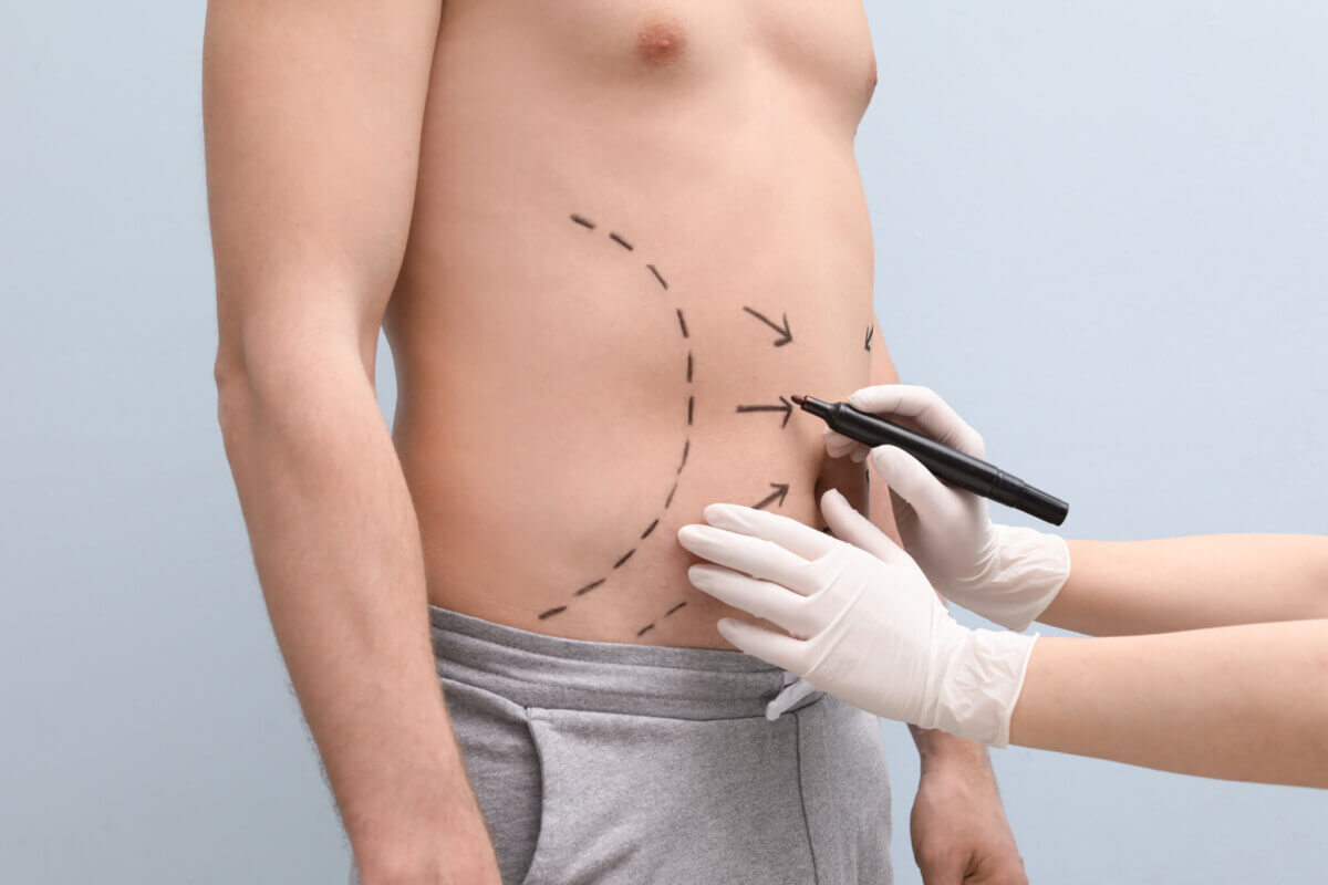 Doctor drawing lines on man’s stomach for plastic surgery