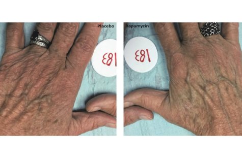 Rapamycin effects on skin