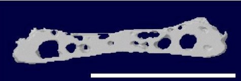 Swiss cheese bones may cause back pain