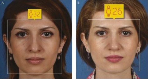 Rhinoplasty