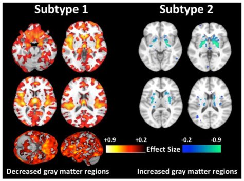 Two type of schizophrenia discovered