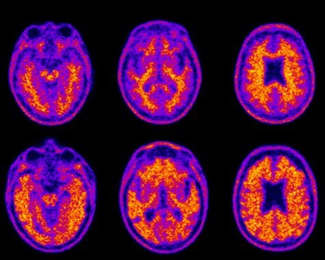 Dementia brain scans