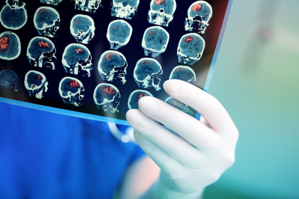 Doctor looks at brain scans