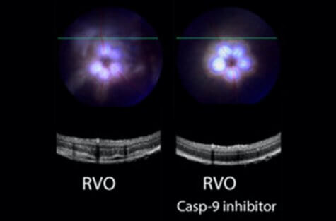 Eyedrops that prevent retinal condition that causes blindness