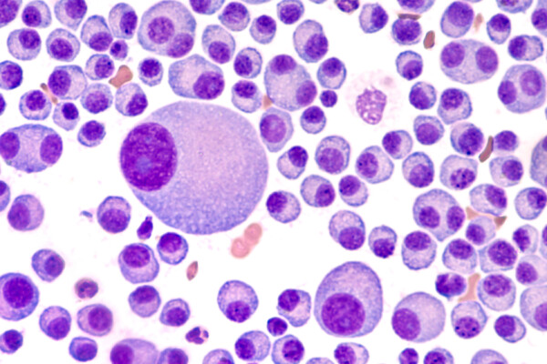 Bone marrow cancer cells - multiple myeloma