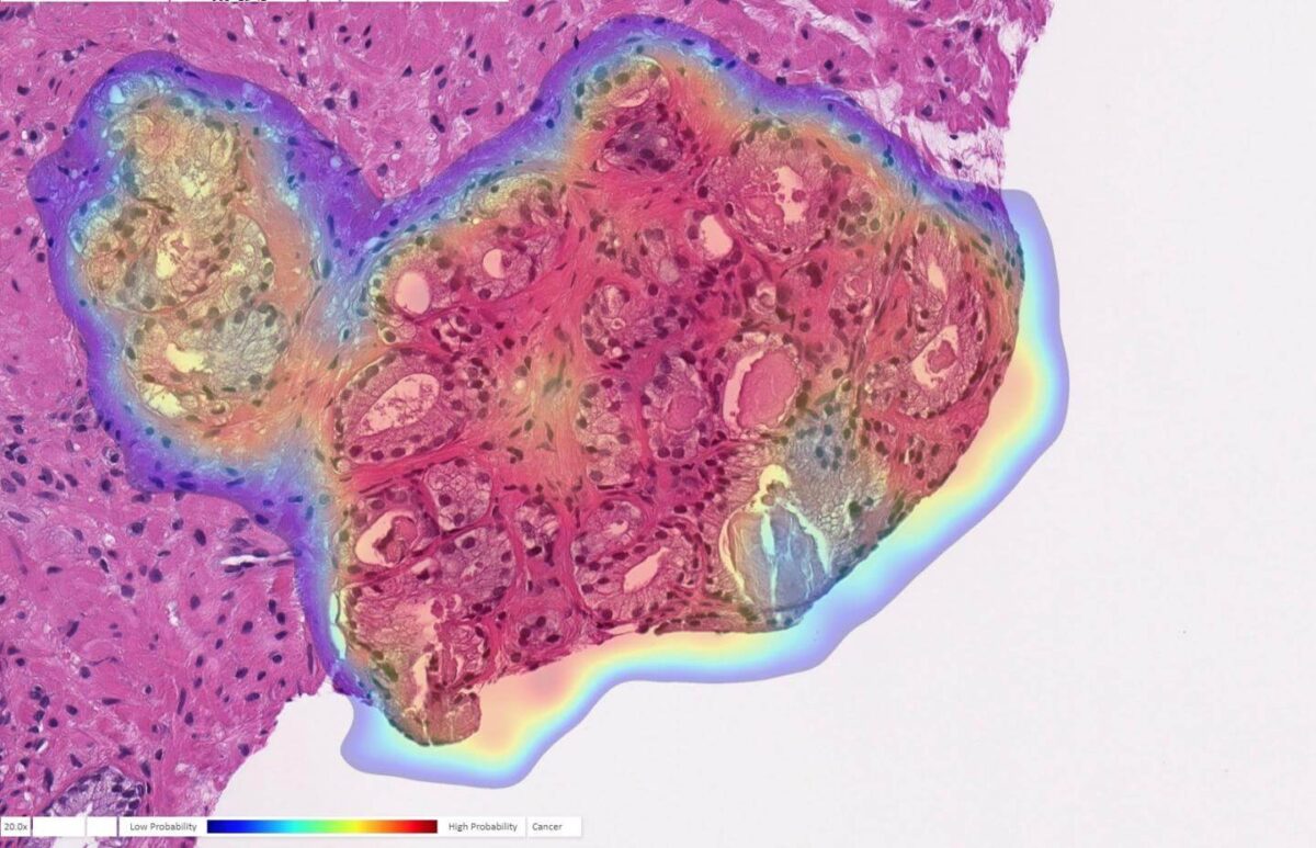 Prostate biopsy