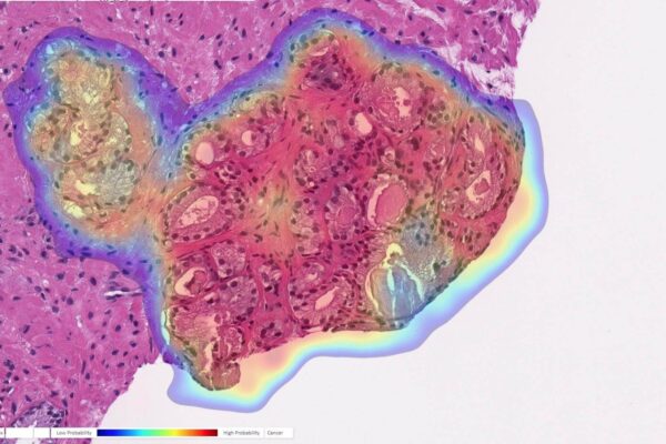 Prostate biopsy with cancer probability (blue is low, red is high).