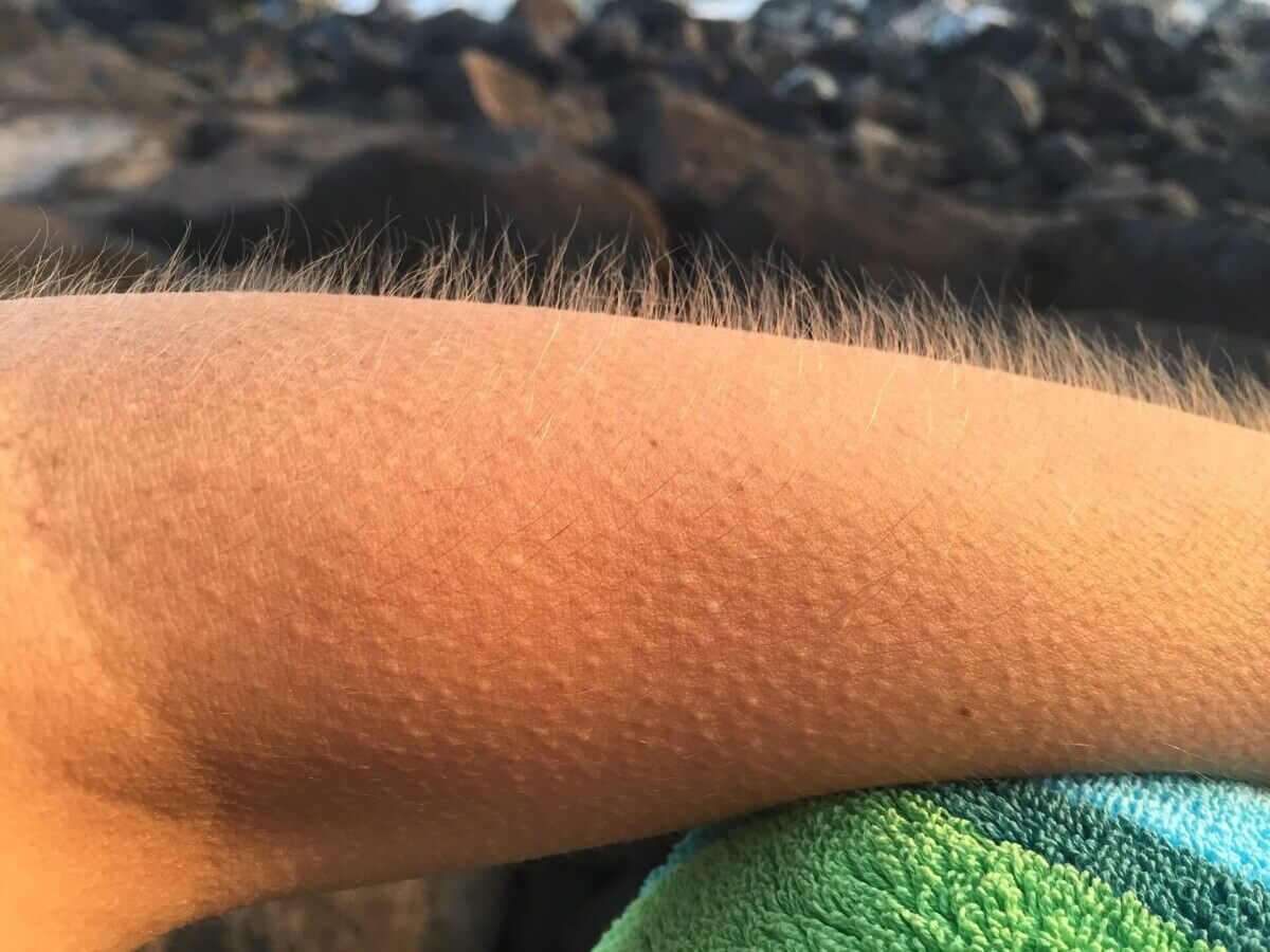 Goosebumps