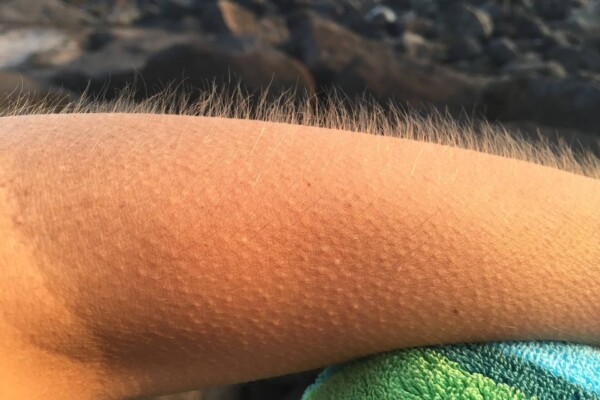 Goosebumps