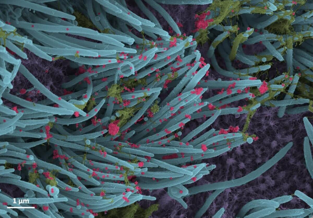 A higher power magnification image shows the structure and density of SARS-CoV-2 virions