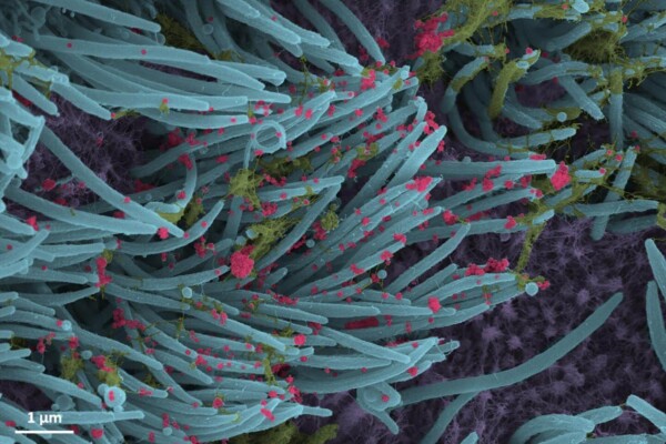 A higher power magnification image shows the structure and density of SARS-CoV-2 virions
