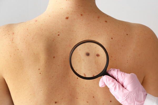 Mole on woman's back as doctor checks for skin cancer