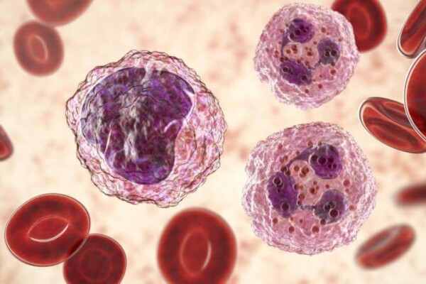Leukemia Cancer