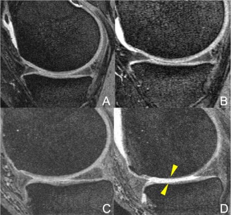 MRI Knee Degeneration