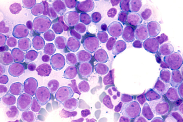 Acute Myeloid Leukemia