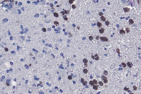 brain cancer dead cells