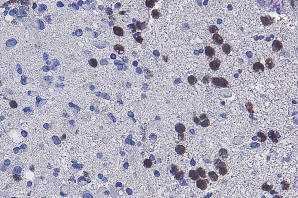 Neutrophils, stained brown, are visible in a human glioblastoma tissue sample