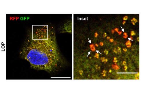 diarrhea drug brain cancer