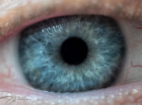 glaucoma eye