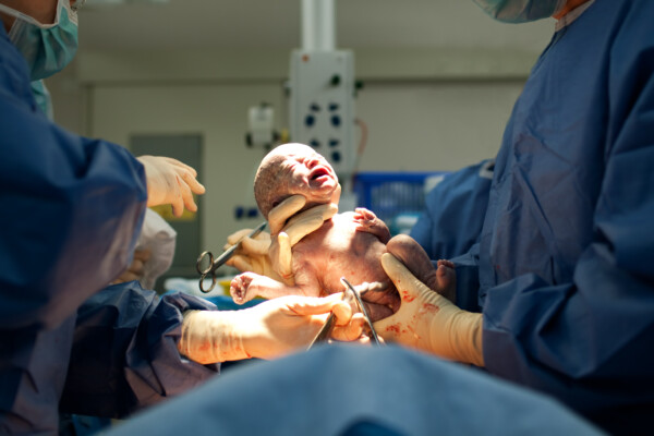 Newborn baby born by C-section