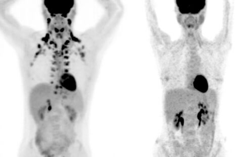 brown fat PET Scan