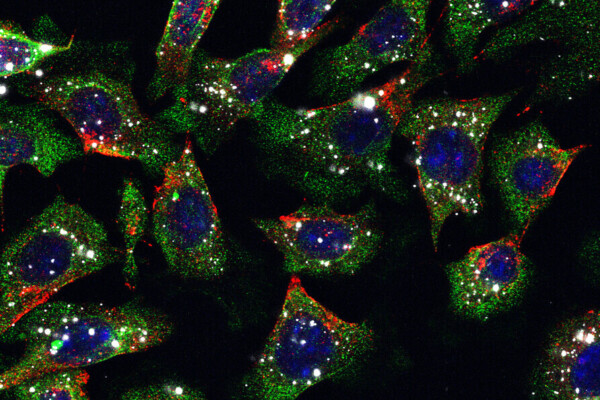 skin cancer nanoparticles