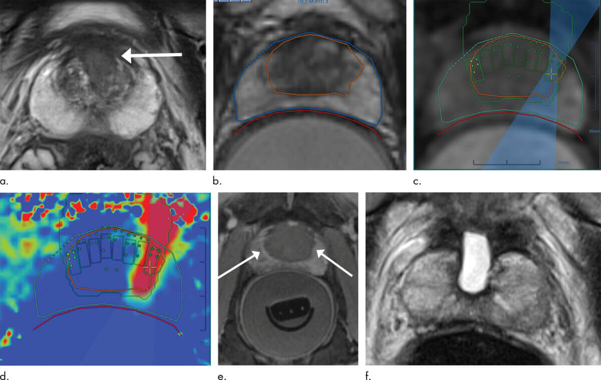 Prostate cancer cured by sound waves