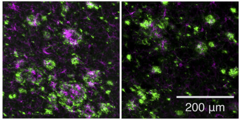 Amyloid plaques