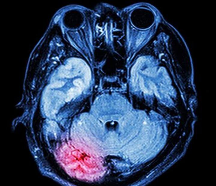 X-ray shows a concussion in the brain