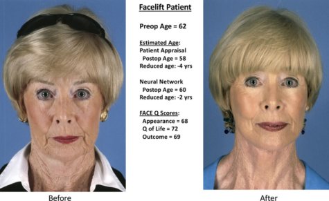 facelift results