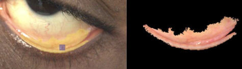 Eyelid scan from smartphone