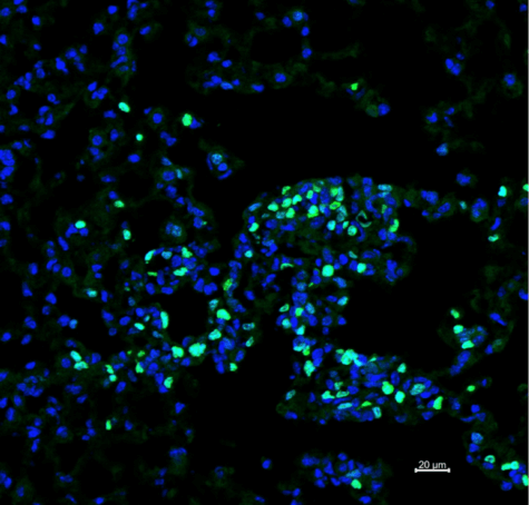 white blood cells cancer