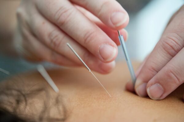 Acupuncture for neck and back pain