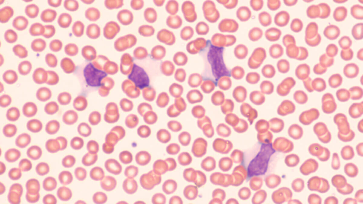Photomicrograph of peripheral blood smear showing atypical lymphocytes in patient with infectious mononucleosis.  This illness, caused by the Epstein Barr virus, is also know as the “kissing disease”.