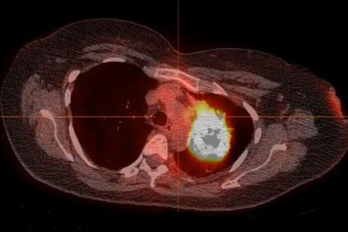 Never Smoker Lung Cancer
