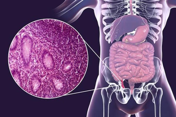 appendicitis