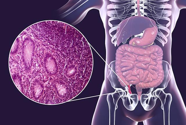 appendicitis