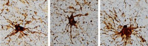 zombie cells