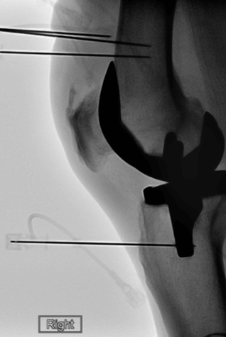 Knee replacement