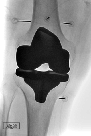 Knee replacement