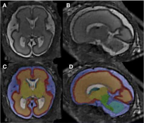 Alcohol / baby brain scan