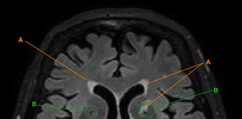 brain scan