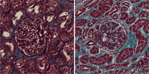 kidney covid