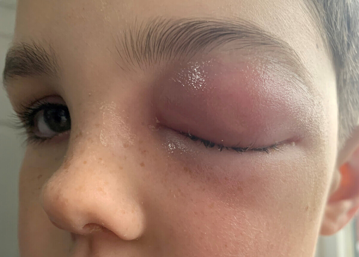 Zac Morey COVID eye