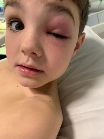 Zac Morey - COVID eye