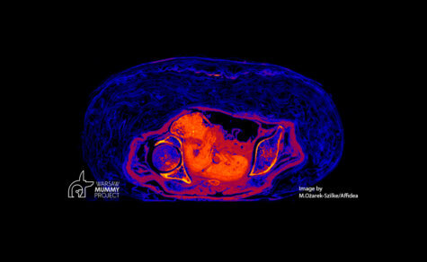 ct scan fetus