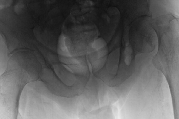 hip xray