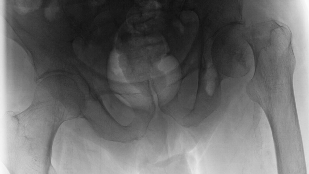 hip xray