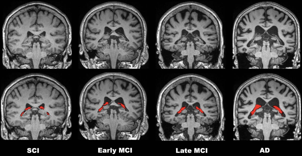 Brain scans show Alzheimer’s disease progression
