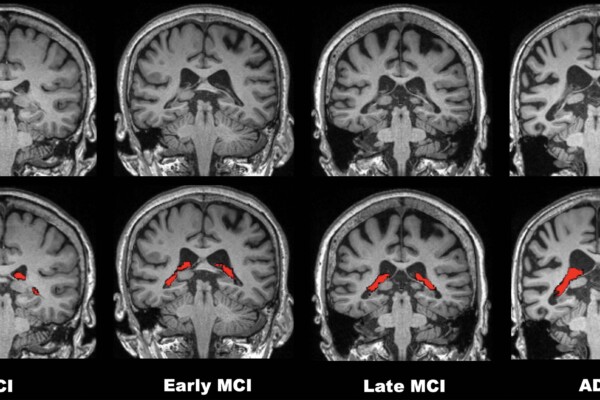 Brain scan for Alzheimer's / MCI